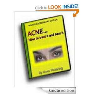 Acne   How to Treat It and Beat It Jane Brown  Kindle 