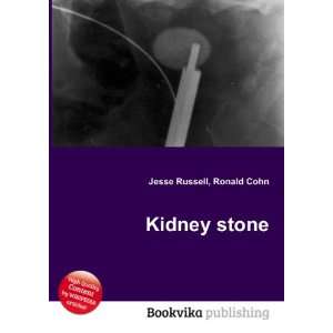  Kidney stone Ronald Cohn Jesse Russell Books